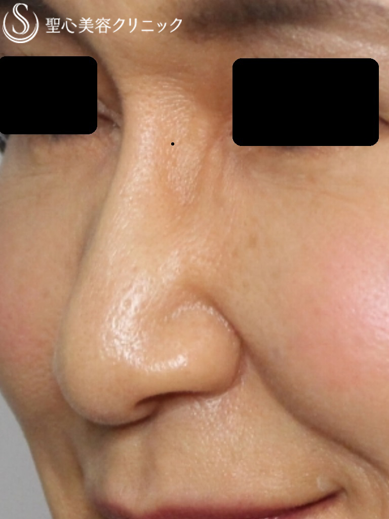 【60代女性・鼻筋を綺麗にしたい】G-mesh(糸で鼻筋を通す）（3ヶ月後） After 