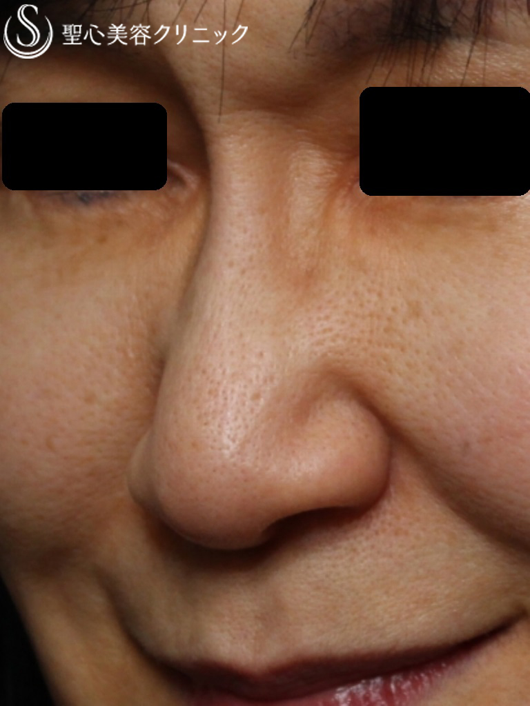 【60代女性・鼻筋を綺麗にしたい】G-mesh(糸で鼻筋を通す）（3ヶ月後） Before 