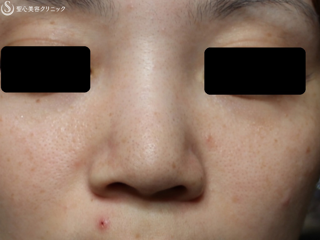 【20代女性・鼻筋全体をほっそりしたい】鼻尖縮小+クレヴィエル（1ヶ月後+注入直後） Before 