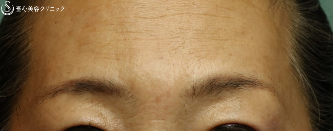 【50代女性・眉間・鼻根のしわ】プレミアムPRP皮膚再生療法（3ヶ月後） After 