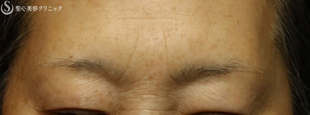 【50代女性・眉間・鼻根のしわ】プレミアムPRP皮膚再生療法（3ヶ月後） Before 