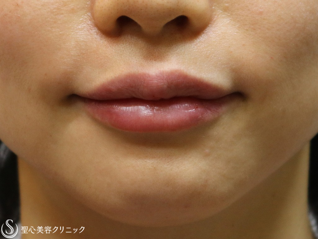 【30代女性・口角をあげて唇を自然にふっくら】スマイルリップ（ジュビダームビスタボルベラ）（施術直後） After 