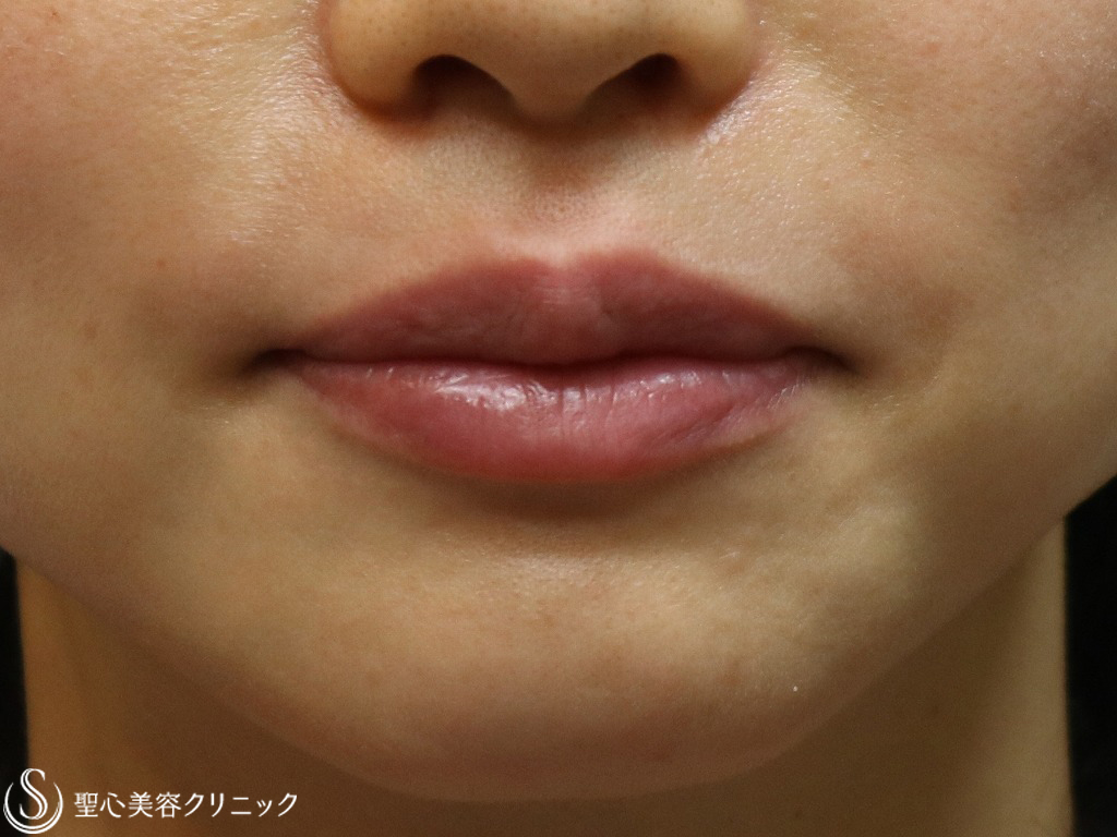 【30代女性・口角をあげて唇を自然にふっくら】スマイルリップ（ジュビダームビスタボルベラ）（施術直後） Before 
