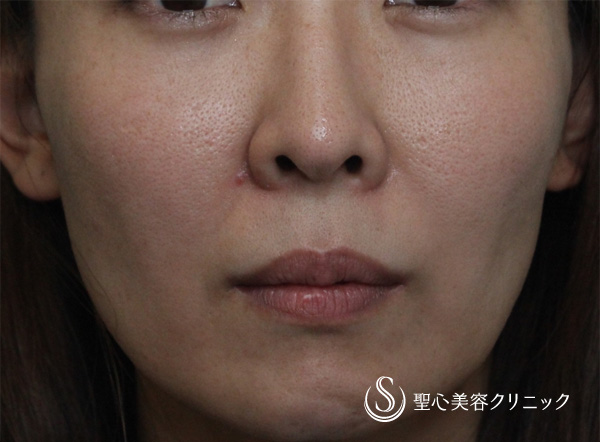 【女性・ほうれい線、たるみ改善後２年経過】プレミアムPRP皮膚再生療法（２年後） After 