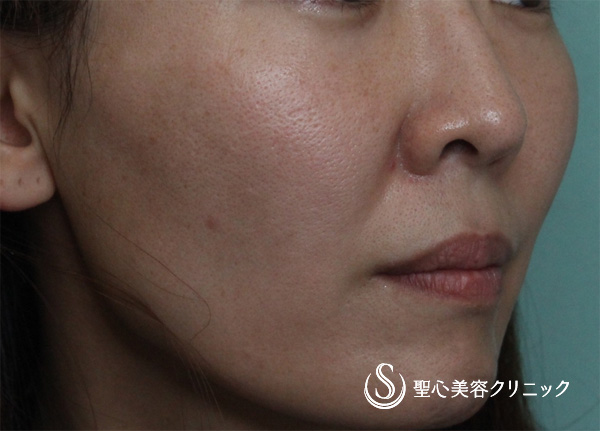【女性・ほうれい線、たるみ改善後２年経過】プレミアムPRP皮膚再生療法（２年後） After 