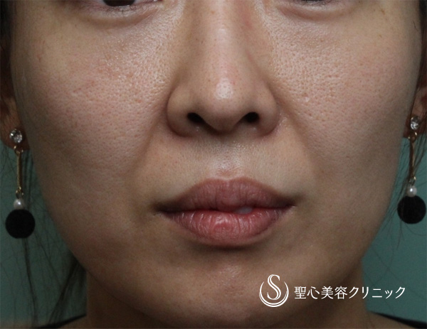 【女性・ほうれい線、たるみ改善後２年経過】プレミアムPRP皮膚再生療法（２年後） Before 