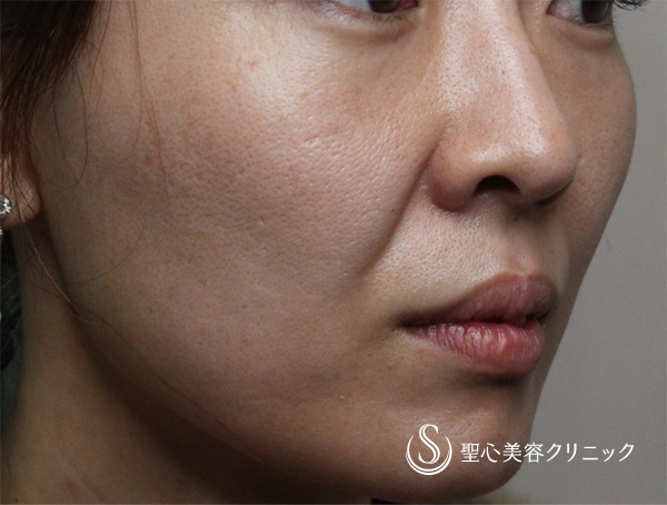 【女性・ほうれい線、たるみ改善後２年経過】プレミアムPRP皮膚再生療法（２年後） Before 