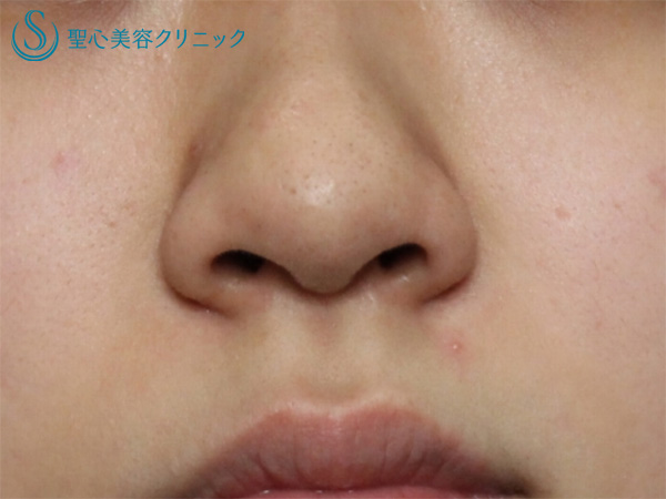 【20代女性・理想の鼻に整える】鼻尖縮小+耳介軟骨移植+小鼻縮小(1か月後） Before 