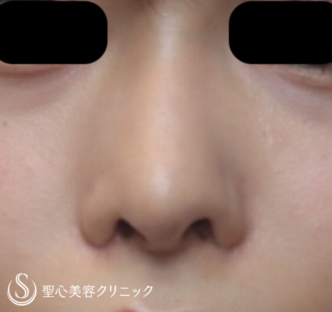 【20代女性･鼻の穴を見えにくく】鼻孔縁下降術（半年後） After 