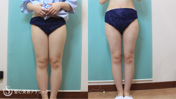 【20代女性・大腿と下腿をスッキリと】大腿・膝・下腿・足首の脂肪吸引（1ヶ月後） After 