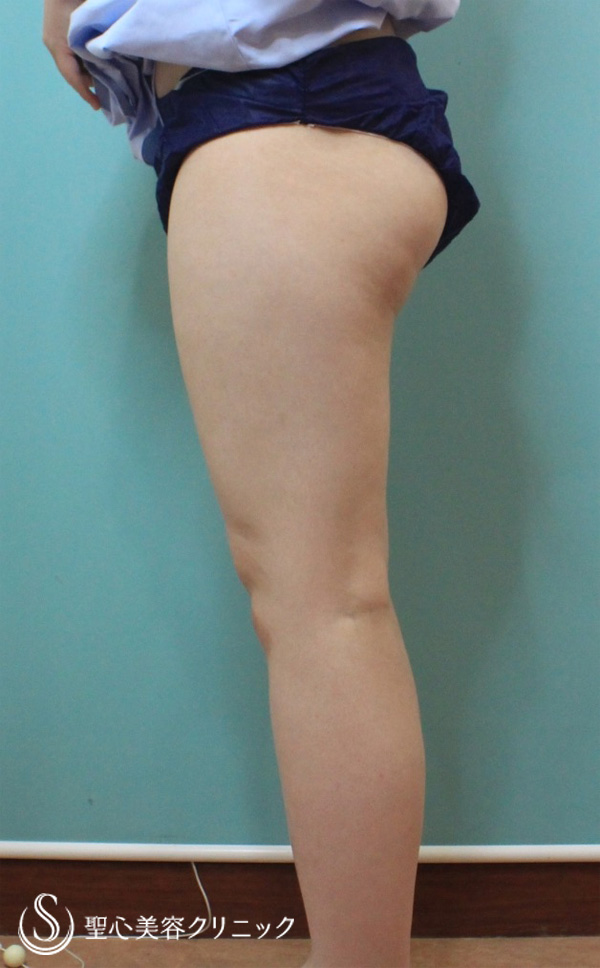 【20代女性・大腿と下腿をスッキリと】大腿・膝・下腿・足首の脂肪吸引（1ヶ月後） Before 