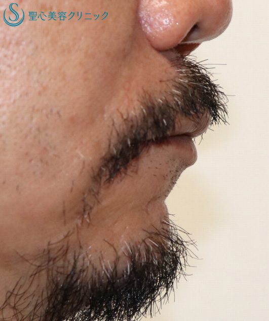 【50代男性・小さなアゴ】顎プロテーゼ（１ヶ月後） After 