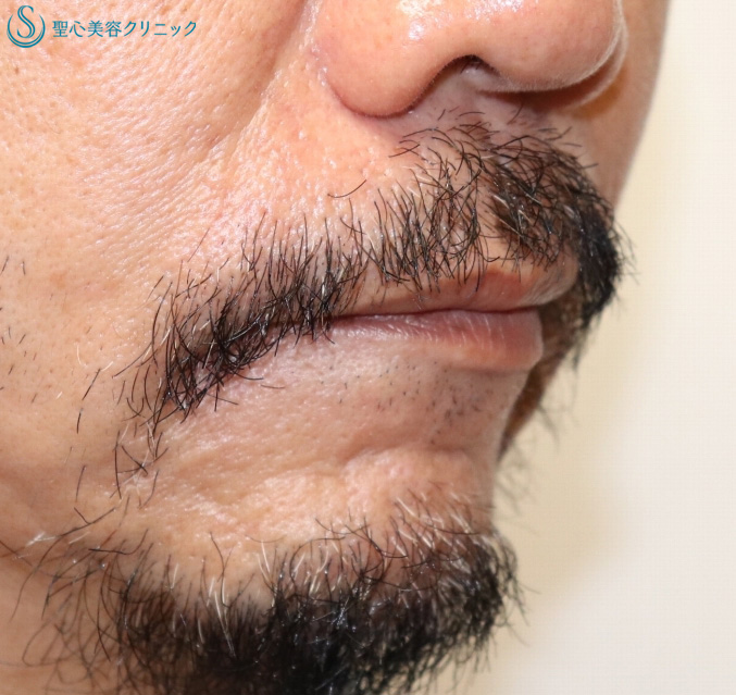 【50代男性・小さなアゴ】顎プロテーゼ（１ヶ月後） After 