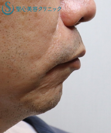 50代男性 小さなアゴ 顎プロテーゼ 1ヶ月後 症例写真 美容整形 美容外科なら聖心美容クリニック 50代男性 小さなアゴ 顎プロテーゼ 1ヶ月後 症例写真 美容整形 美容外科なら聖心美容クリニック