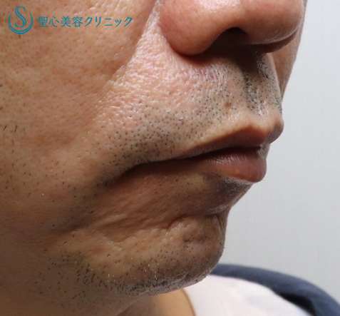 【50代男性・小さなアゴ】顎プロテーゼ（１ヶ月後） Before 