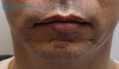 【50代男性・小さなアゴ】顎プロテーゼ（１ヶ月後） Before 