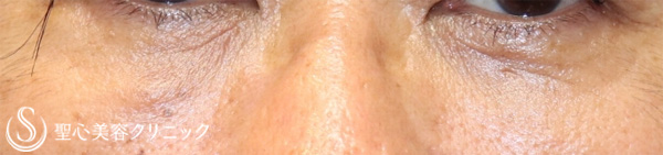【50代男性・目の下の凹みを注入だけで改善】プレミアムPRP皮膚再生療法（1か月後） After 