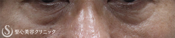 【50代男性・目の下の凹みを注入だけで改善】プレミアムPRP皮膚再生療法（1か月後） Before 
