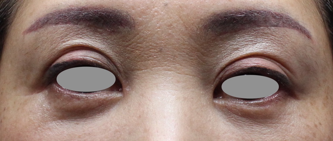 【50代女性・上まぶたのたるみ・目の下の凹みを修正】眉下リフト+プレミアムPRP皮膚再生療法（1ヶ月後） After 