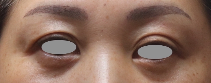【50代女性・上まぶたのたるみ・目の下の凹みを修正】眉下リフト+プレミアムPRP皮膚再生療法（1ヶ月後） Before 