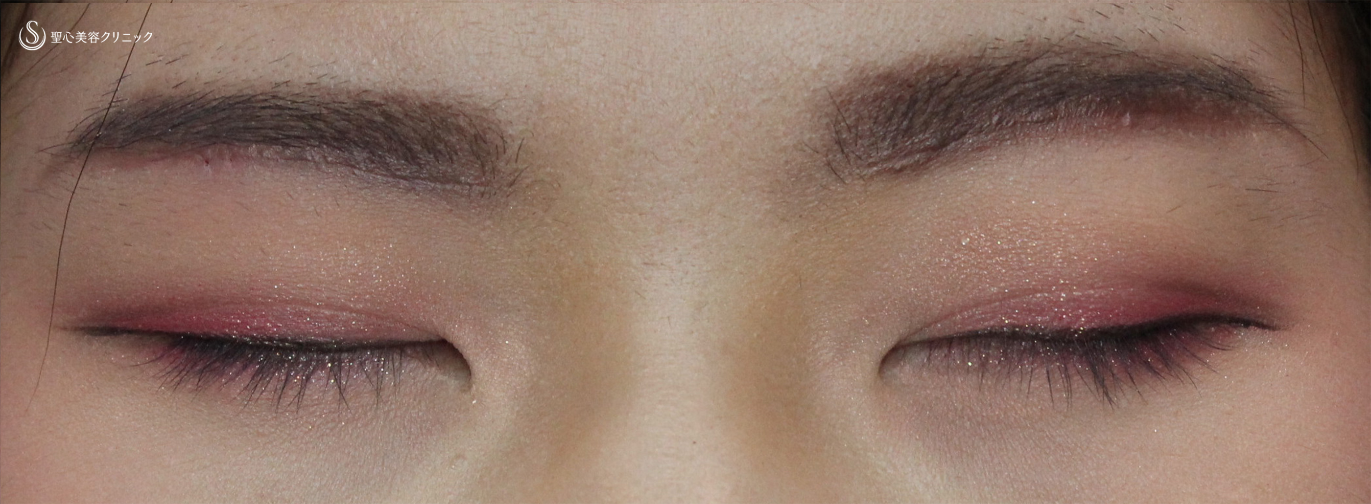【20代女性・厚い瞼を薄く、はっきりとした二重へ！】眉下切開法（眉下リフト）（1ヶ月後） After 