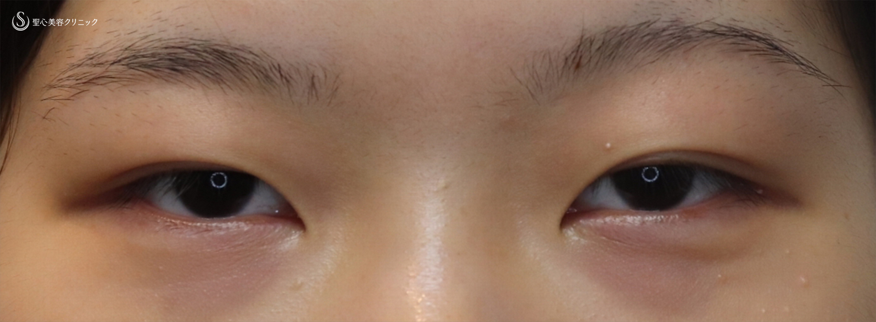 【20代女性・厚い瞼を薄く、はっきりとした二重へ！】眉下切開法（眉下リフト）（1ヶ月後） Before 