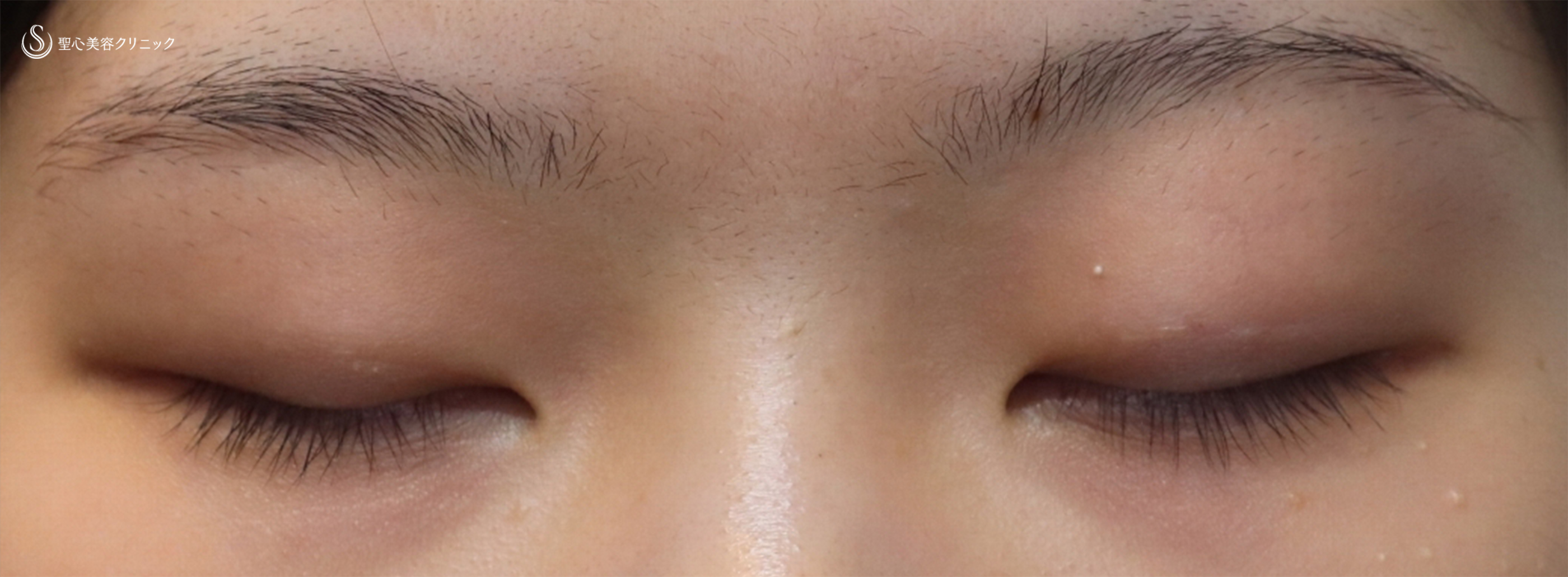 【20代女性・厚い瞼を薄く、はっきりとした二重へ！】眉下切開法（眉下リフト）（1ヶ月後） Before 