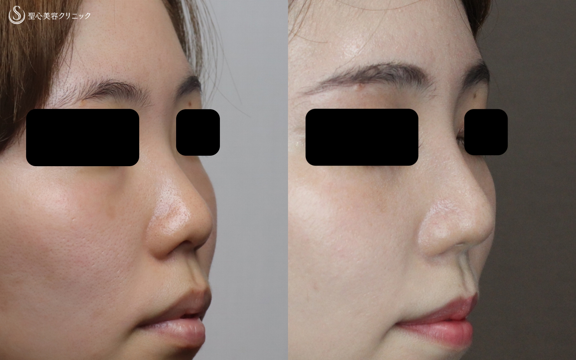【20代女性・鼻全体を綺麗に】プロテーゼ挿入、鼻尖縮小、耳介軟骨移植（1ヶ月後） After 