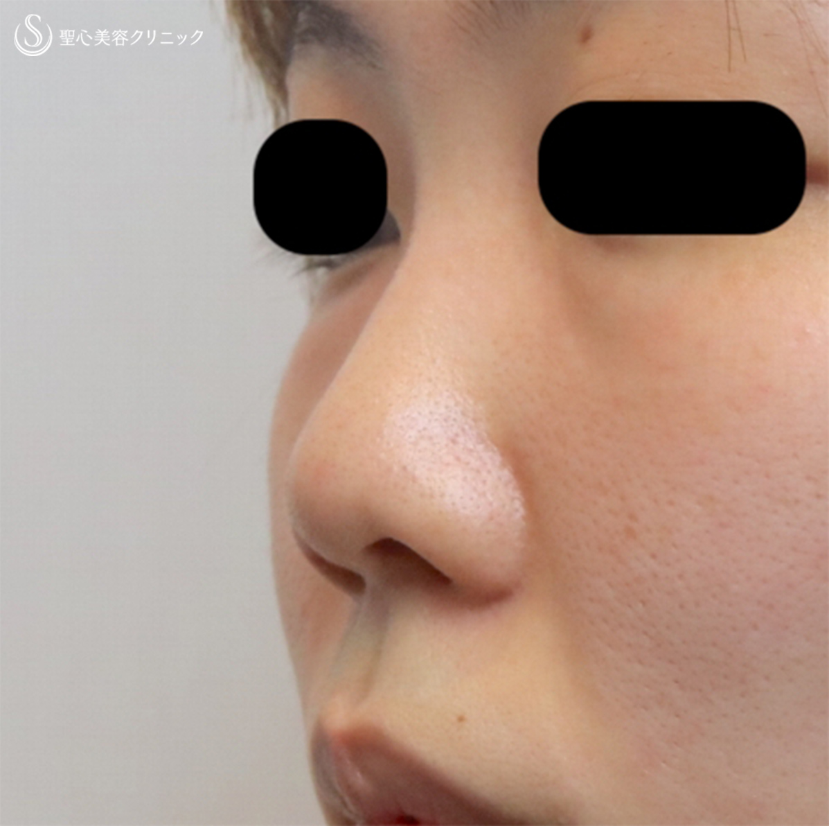 【20代女性・鼻全体を綺麗に】プロテーゼ挿入、鼻尖縮小、耳介軟骨移植（1ヶ月後） Before 