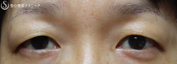 【40代女性・重たい瞼をすっきりと】眉下切開（１ヶ月後） Before 