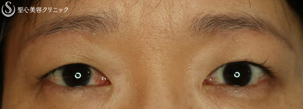 【40代女性・重たい瞼をすっきりと】眉下切開（１ヶ月後） After 