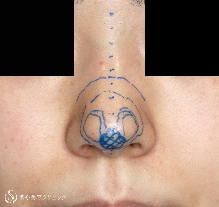 【20代女性・耳介軟骨は不要】鼻尖縮小術+α法（1ヶ月後） Before 