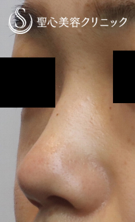 【30代女性・だんご鼻をスッキリと】鼻尖縮小＋耳介軟骨移植（１ヶ月後） Before 