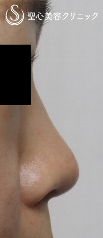 【30代女性・だんご鼻をスッキリと】鼻尖縮小＋耳介軟骨移植（１ヶ月後） Before 