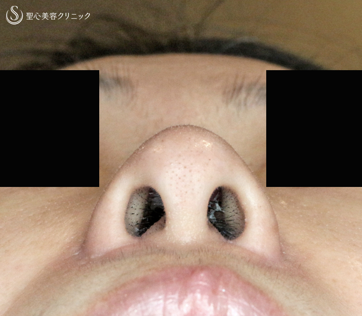 【40代女性・正面から鼻の穴が見える】小鼻縮小術+α法（4ヶ月後） After 