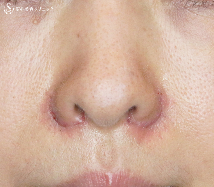 【40代女性・正面から鼻の穴が見える】小鼻縮小術+α法（4ヶ月後） After 