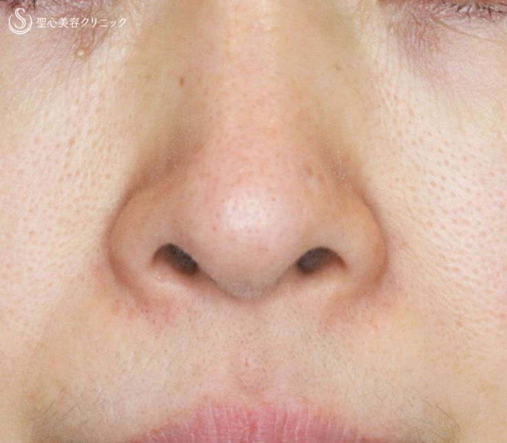 【40代女性・正面から鼻の穴が見える】小鼻縮小術+α法（4ヶ月後） Before 