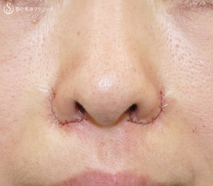【40代女性・正面から鼻の穴が見える】小鼻縮小術+α法（4ヶ月後） Before 