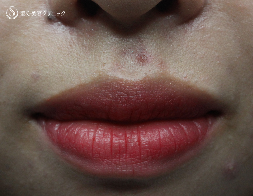 代女性 唇を薄く 口唇縮小術 術後1ヶ月 症例写真 美容整形 美容外科なら聖心美容クリニック 代女性 唇を薄く 口唇縮小術 術後1ヶ月 症例写真 美容整形 美容外科なら聖心美容クリニック