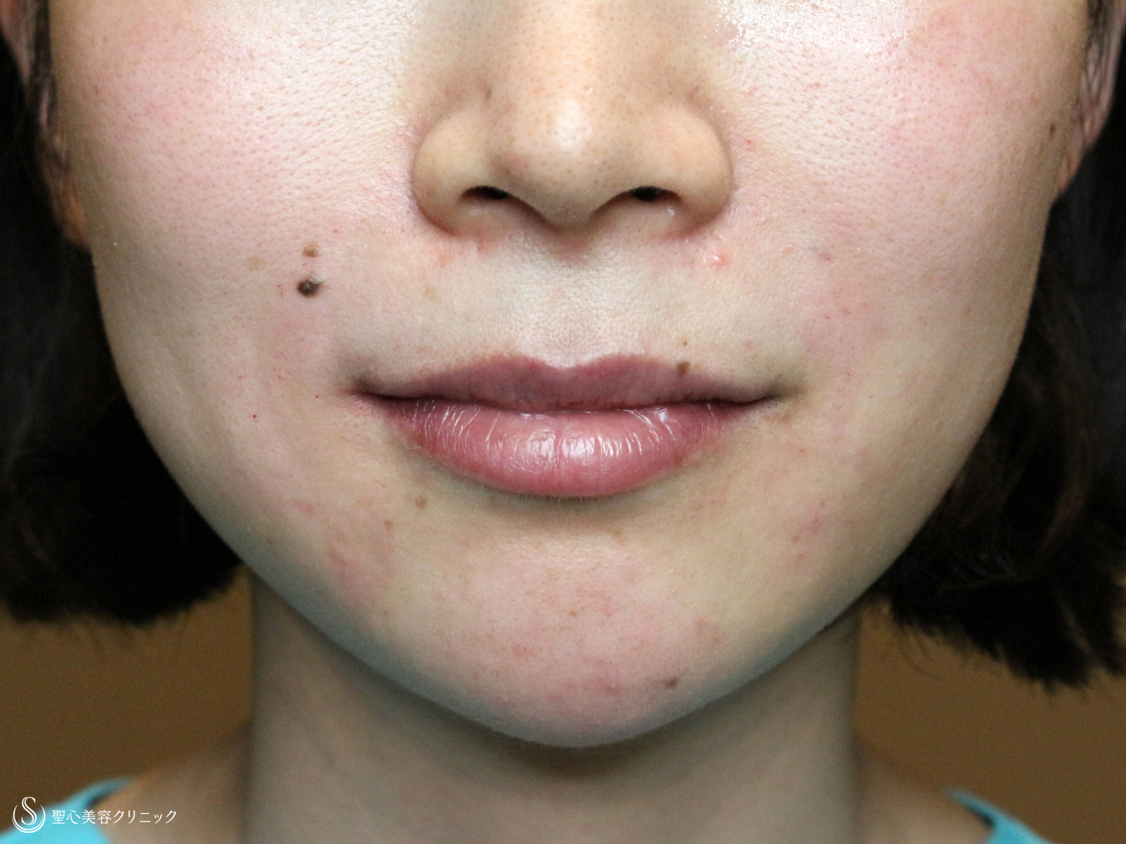 【30代女性スタッフ・法令線を消す+α】プレミアムPRP皮膚再生療法（6ヶ月後） Before 