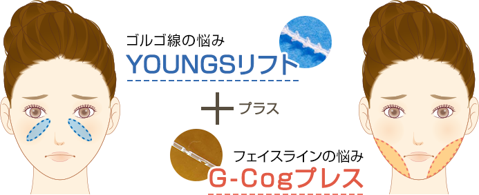 ゴルゴ線の悩み YOUNGSリフト ＋ フェイスラインの悩み G-Cogプレス