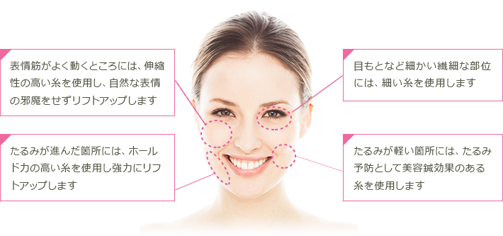 表情筋がよく動くところには、伸縮性の高い糸を使用し、自然な表情の邪魔をせずリフトアップします たるみが進んだ箇所には、ホールド力の高い糸を使用し協力にリフトアップします 目もとなど細かい繊細な部位には、細い糸を使用します たるみが軽い箇所には、たるみ予防として美容鍼効果のある糸を使用します
