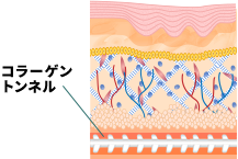 ④糸の周りにコラーゲントンネルが形成されることでもリフトアップ＆美肌を長期間キープ