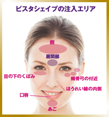 ビスタシェイプの注入エリア