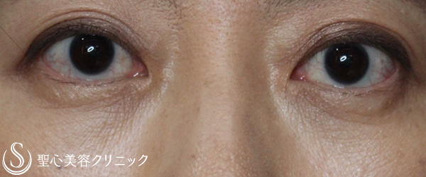 【40代女性・目の開きをよく】眼瞼下垂修正(埋没法)（13年後） After 