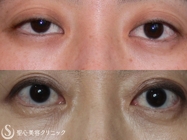 【40代女性・目の開きをよく】眼瞼下垂修正(埋没法)（13年後） After 