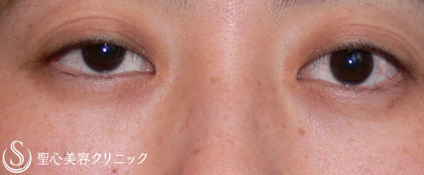 【40代女性・目の開きをよく】眼瞼下垂修正(埋没法)（13年後） Before 