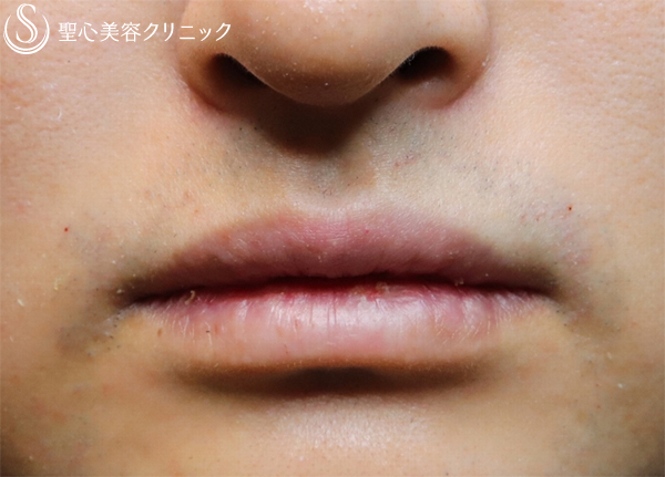 【20代男性・唇を薄く】口唇縮小術（１ヶ月後） After 