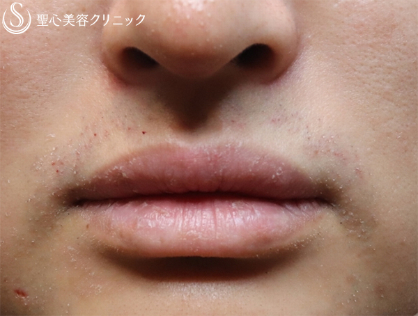 【20代男性・唇を薄く】口唇縮小術（１ヶ月後） Before 