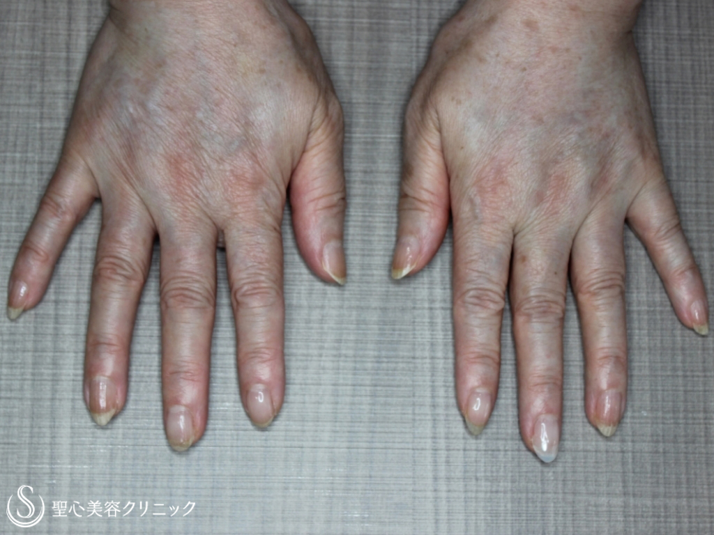 【70代女性・手の甲の若返り】プレミアムPRP皮膚再生療法（1か月後） After 